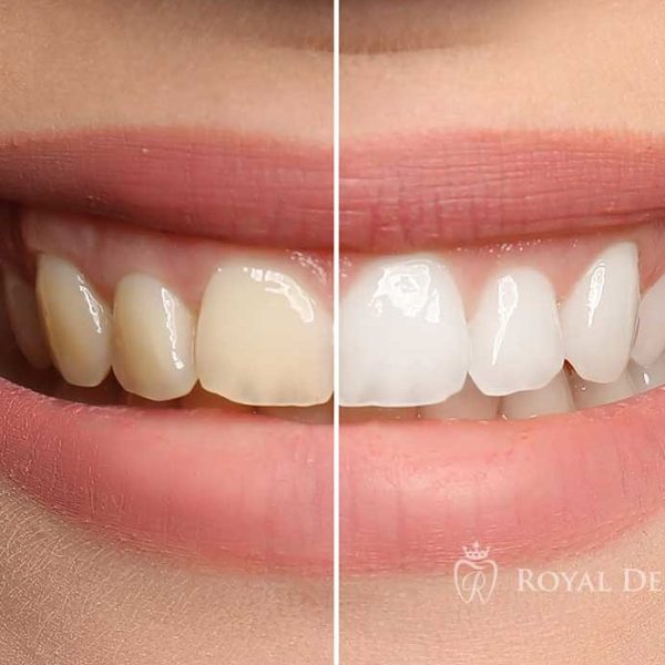 Brighten your smile: 5 Compelling Reasons to Embrace Teeth White