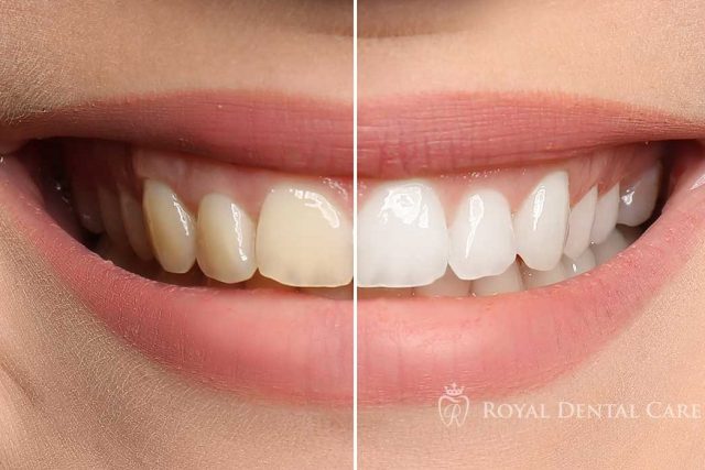 Brighten your smile: 5 Compelling Reasons to Embrace Teeth White