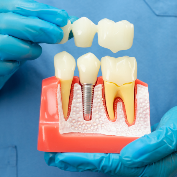 What Happens If You Delay a Crown or Bridge in Penrith? The Risks Dentists Don’t Emphasize Enough